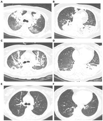 Omadacycline for the treatment of severe pneumonia caused by Chlamydia psittaci complicated with acute respiratory distress syndrome during the COVID-19 pandemic